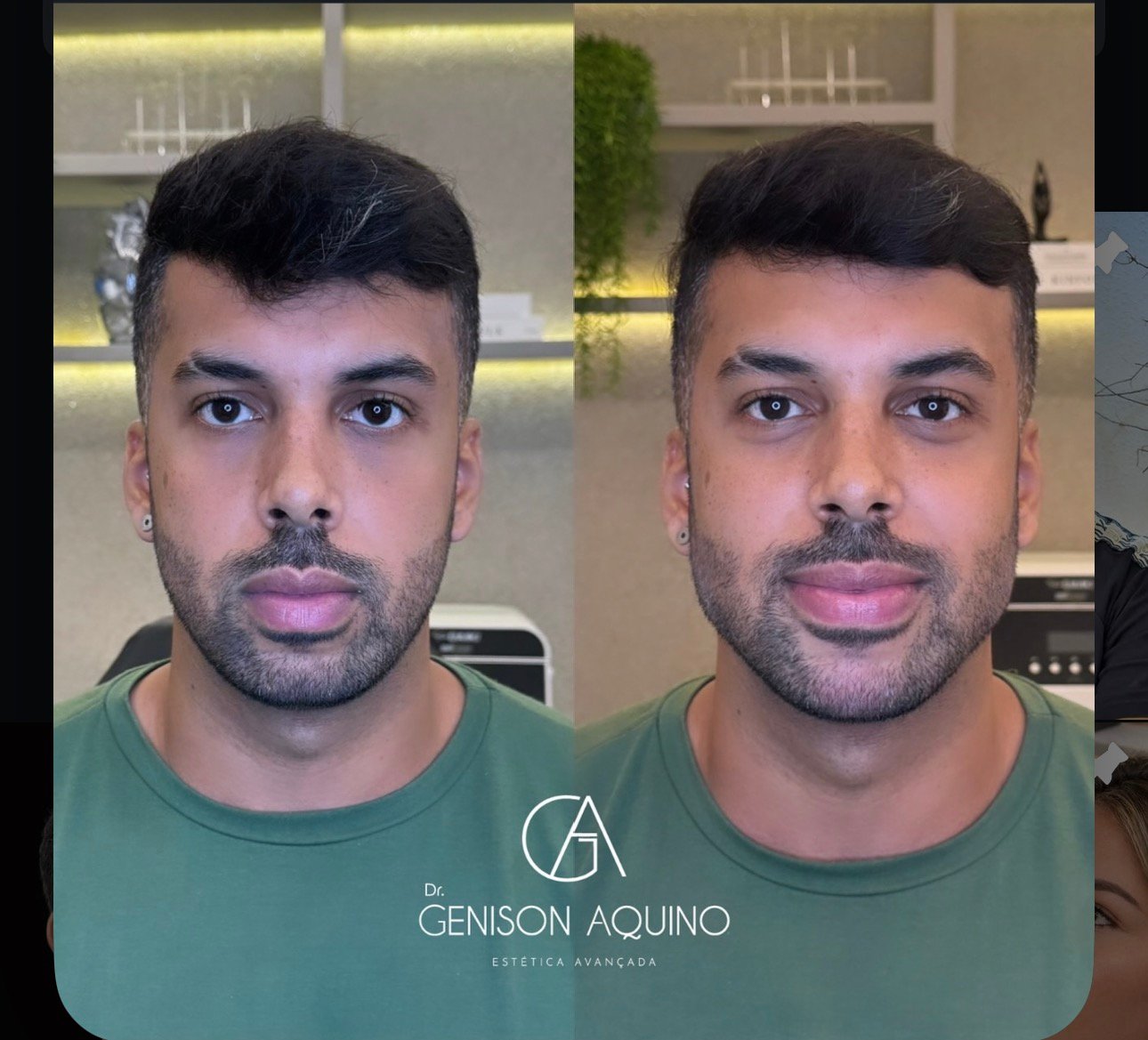 Antes e depois de paciente atendido pelo Dr. Genison Aquino, rosto de frente